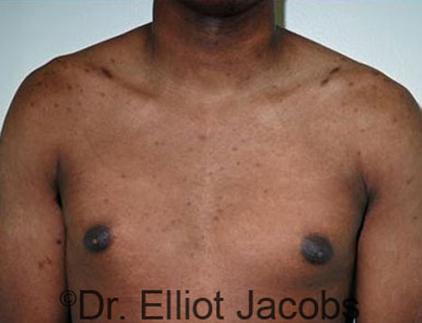 Male breast, before Gynecomastia treatment, front view, patient 72