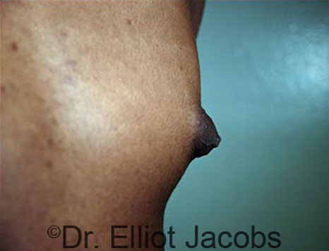 Male nipple, before Gynecomastia treatment, oblique view - patient 72