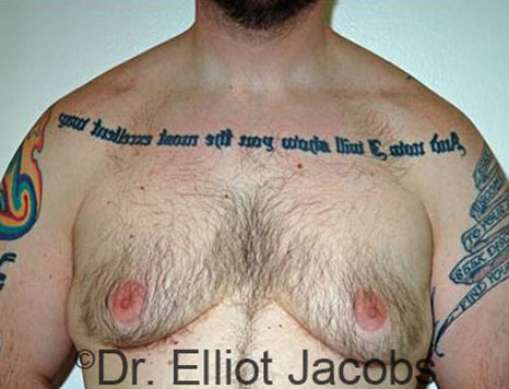 Male breast, before Gynecomastia treatment, front view, patient 73