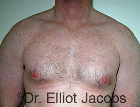 Male breast, before Gynecomastia treatment, front view, patient 74
