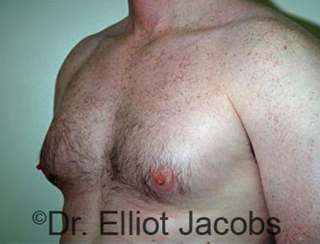 Male breast, before Gynecomastia treatment, l-side oblique view - patient 74