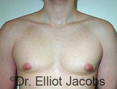 Male breast, before Gynecomastia treatment, front view, patient 75