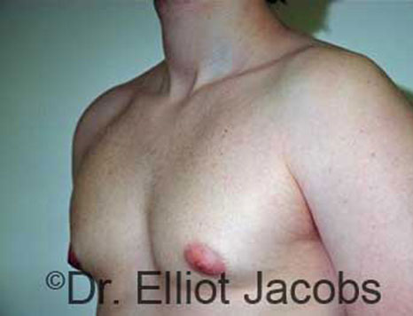 Male breast, before Gynecomastia treatment, l-side oblique view - patient 75