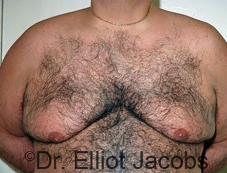Male breast, before Gynecomastia treatment, front view, patient 76