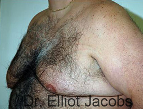 Male breast, before Gynecomastia treatment, l-side oblique view - patient 76