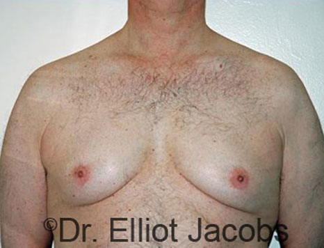 Male breast, before Gynecomastia treatment, front view, patient 77