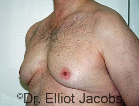 Male breast, before Gynecomastia treatment, l-side oblique view - patient 77
