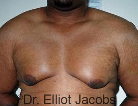 Male breast, before Gynecomastia treatment, front view, patient 78