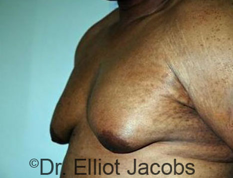 Male breast, before Gynecomastia treatment, l-side oblique view - patient 78