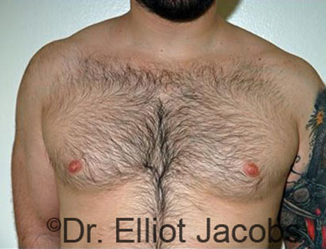 Male breast, before Gynecomastia treatment, front view, patient 79