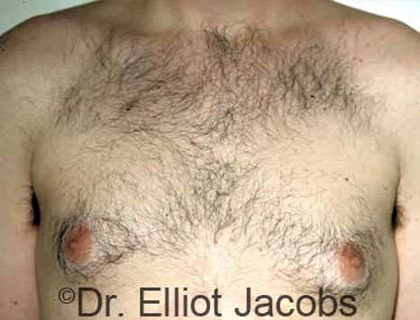 Male breast, before Gynecomastia treatment, front view, patient 8