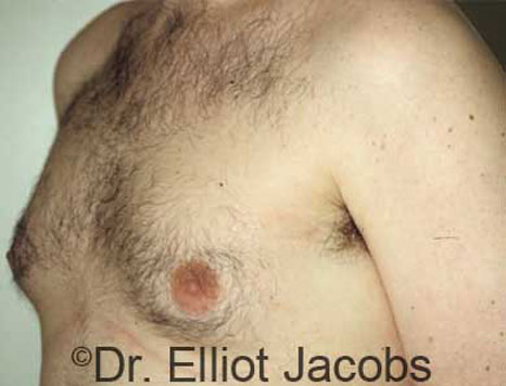 Male breast, before Gynecomastia treatment, l-side oblique view - patient 8