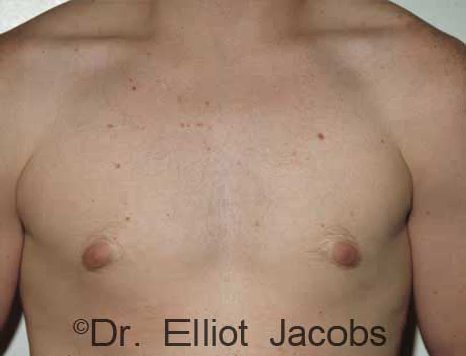 Men's breast, before Gynecomastia Adolescent treatment, front view - patient 1