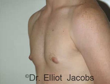 Men's breast, before Gynecomastia Adolescent treatment, oblique view - patient 1