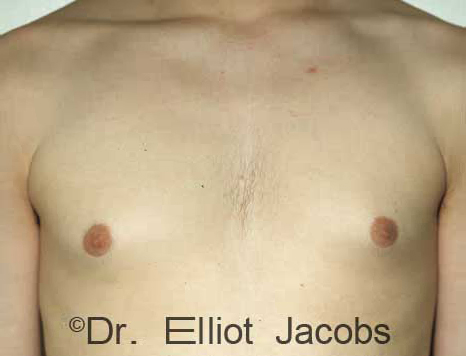 Men's breast, before Gynecomastia Adolescent treatment, front view - patient 2
