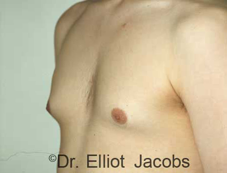 Men's breast, before Gynecomastia Adolescent treatment, oblique view - patient 2