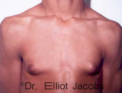 Men's breast, before Gynecomastia Adolescent treatment, front view - patient 3