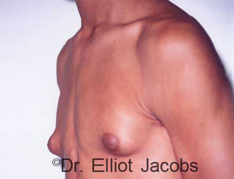 Men's breast, before Gynecomastia Adolescent treatment, oblique view - patient 3