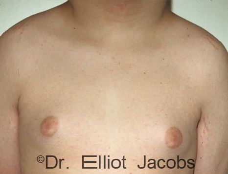 Male breast, before Gynecomastia treatment, front view, patient 83