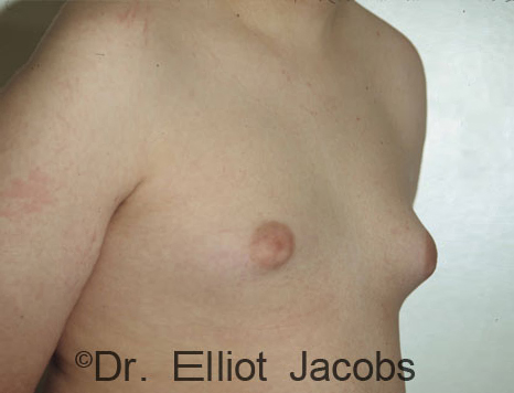 Men's breast, before Gynecomastia Adolescent treatment, oblique view - patient 4
