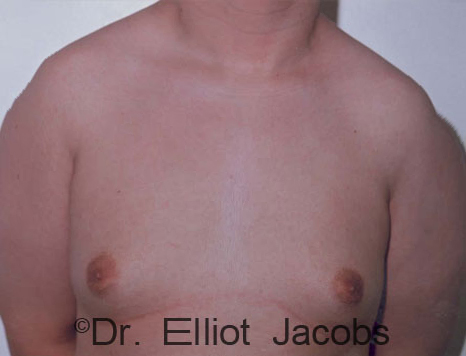 Male breast, before Gynecomastia treatment, front view, patient 84