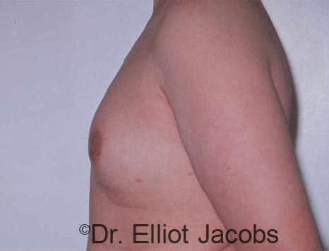 Men's breast, before Gynecomastia Adolescent treatment, oblique view - patient 5