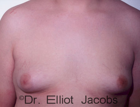 Male breast, before Gynecomastia treatment, front view, patient 85