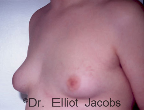Men's breast, before Gynecomastia Adolescent treatment, oblique view - patient 6