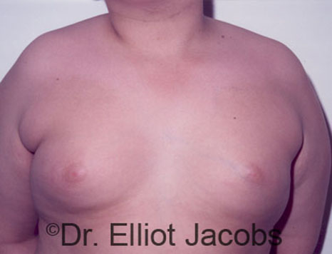 Male breast, before Gynecomastia treatment, front view, patient 86