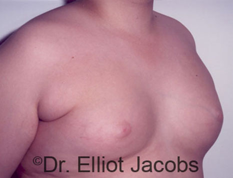 Male breast, before Gynecomastia treatment, r-side oblique view - patient 86