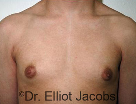 Men's breast, before Gynecomastia Adolescent treatment, front view - patient 8