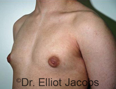 Men's breast, before Gynecomastia Adolescent treatment, oblique view - patient 8