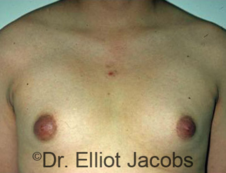 Men's breast, before Gynecomastia Adolescent treatment, front view - patient 9