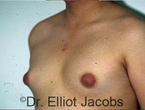 Men's breast, before Gynecomastia Adolescent treatment, oblique view - patient 9