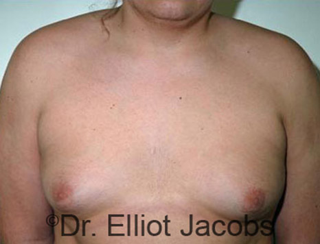 Men's breast, before Gynecomastia Adolescent treatment, front view - patient 10