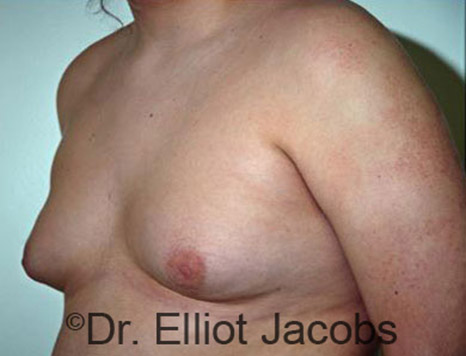 Men's breast, before Gynecomastia Adolescent treatment, oblique view - patient 10
