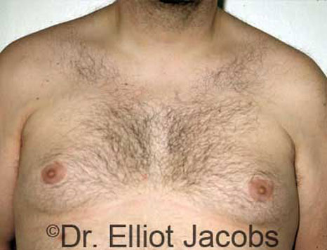 Male breast, before Gynecomastia treatment, front view, patient 9