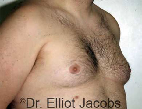 Male breast, before Gynecomastia treatment, r-side oblique view - patient 9