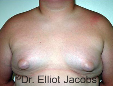 Men's breast, before Gynecomastia Adolescent treatment, front view - patient 11