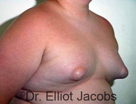 Men's breast, before Gynecomastia Adolescent treatment, oblique view - patient 11