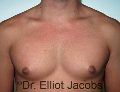 Men's breast, before Gynecomastia Adolescent treatment, front view - patient 12