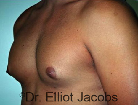 Men's breast, before Gynecomastia Adolescent treatment, oblique view - patient 12