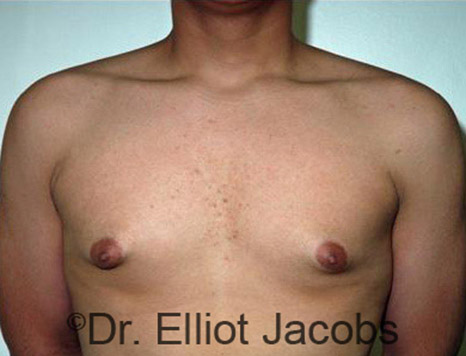Men's breast, before Gynecomastia Adolescent treatment, front view - patient 13