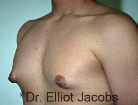 Men's breast, before Gynecomastia Adolescent treatment, oblique view - patient 13