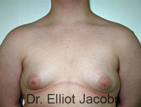 Men's breast, before Gynecomastia Adolescent treatment, front view - patient 14