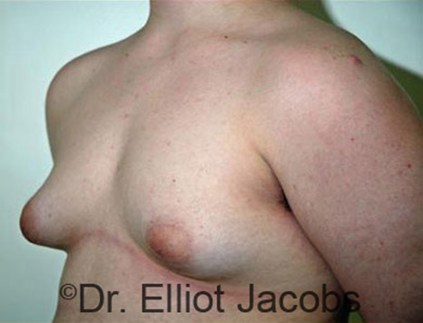 Men's breast, before Gynecomastia Adolescent treatment, oblique view - patient 14