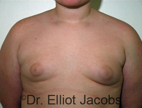 Men's breast, before Gynecomastia Adolescent treatment, front view - patient 15