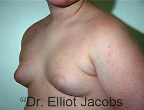 Men's breast, before Gynecomastia Adolescent treatment, oblique view - patient 15