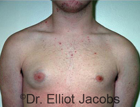 Men's breast, before Gynecomastia Adolescent treatment, front view - patient 16