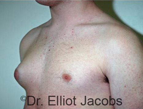 Men's breast, before Gynecomastia Adolescent treatment, oblique view - patient 16